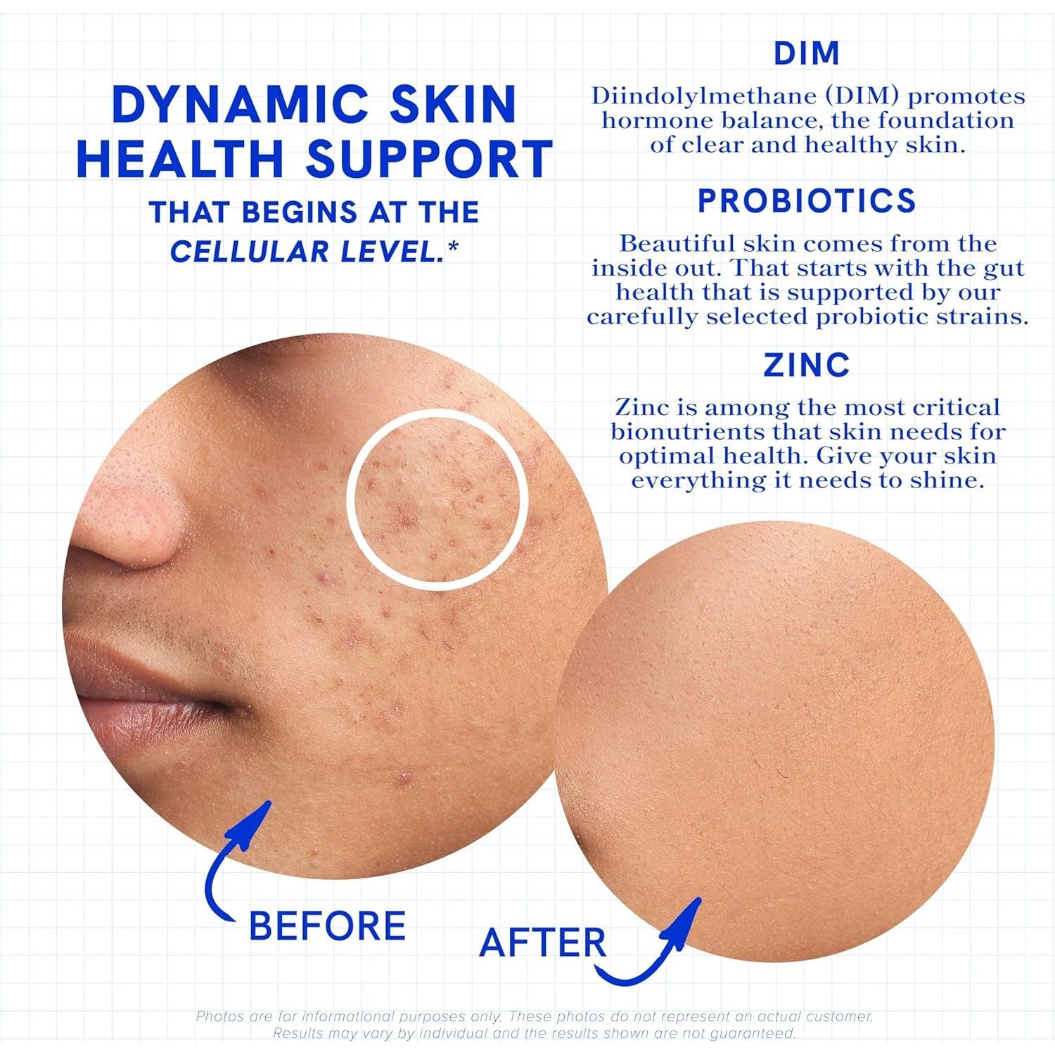 SM Nutrition Clear Acne Support – 120 Capsules | Triple-Action Hormonal, Gut & Skin Nutritional Acne Support