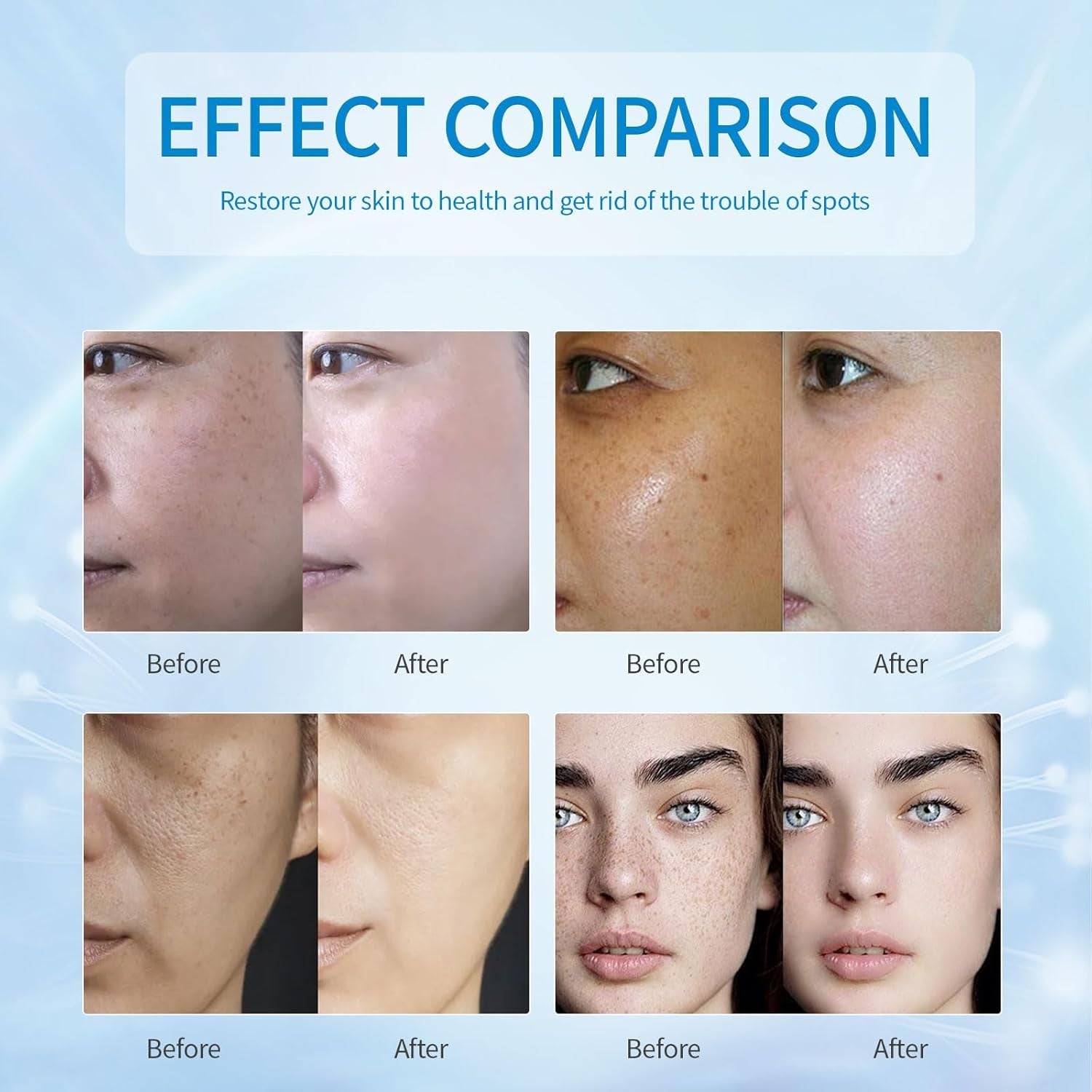 Lindesa Dark Spot Corrector – 30 ml | Advanced Serum for Hyperpigmentation, Melasma, Sun Spots & Uneven Skin Tone