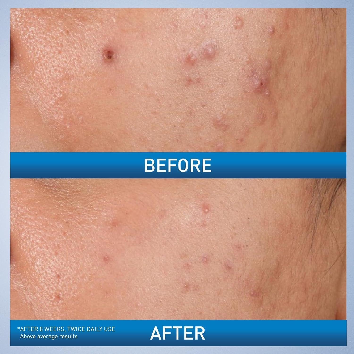 CeraVe Acne Control Gel | AHA/BHA Exfoliant for Clear, Smooth Skin