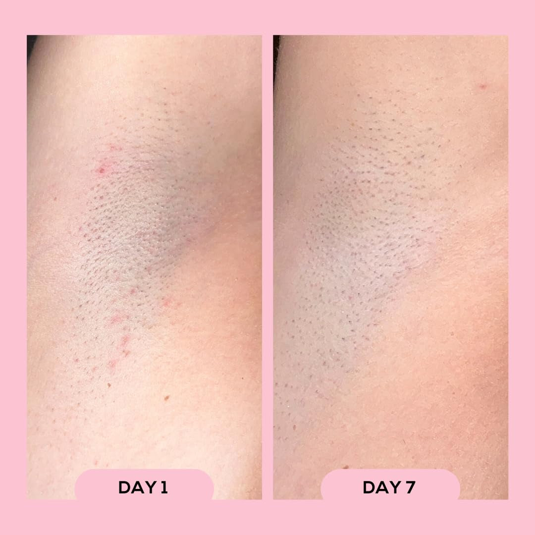 Megababe Après Shave Ingrown & Razor Bump Roll-On Solution 88ml | Award-Winning Ingrown Hair Treatment for Smooth, Bump-Free Skin