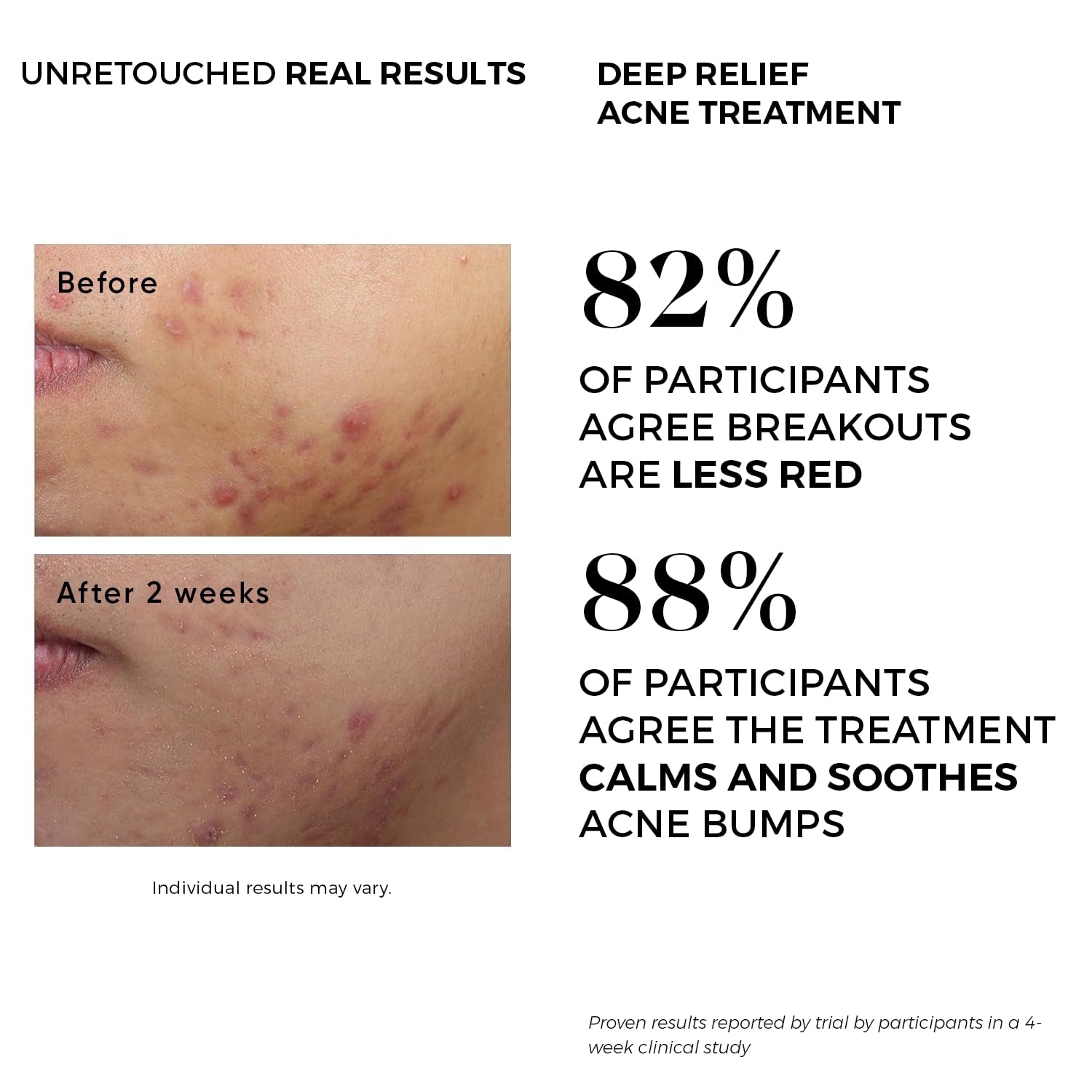 Beauty Facial Extreme Acne Treatment Pads 60 Pads | Salicylic, Glycolic & Lactic Acid Exfoliating Pads for Face & Body