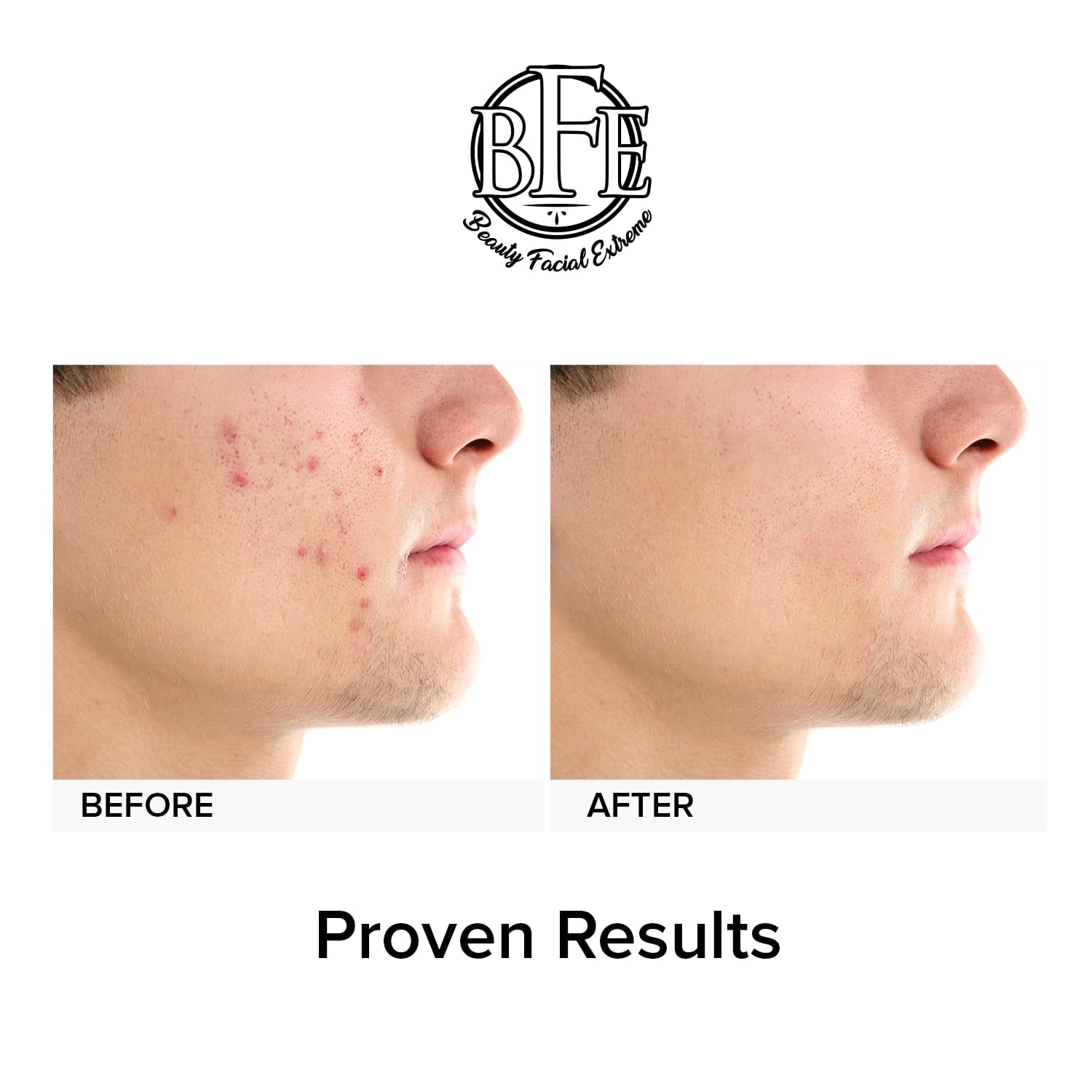 Beauty Facial Extreme Acne Treatment Pads 60 Pads | Salicylic, Glycolic & Lactic Acid Exfoliating Pads for Face & Body