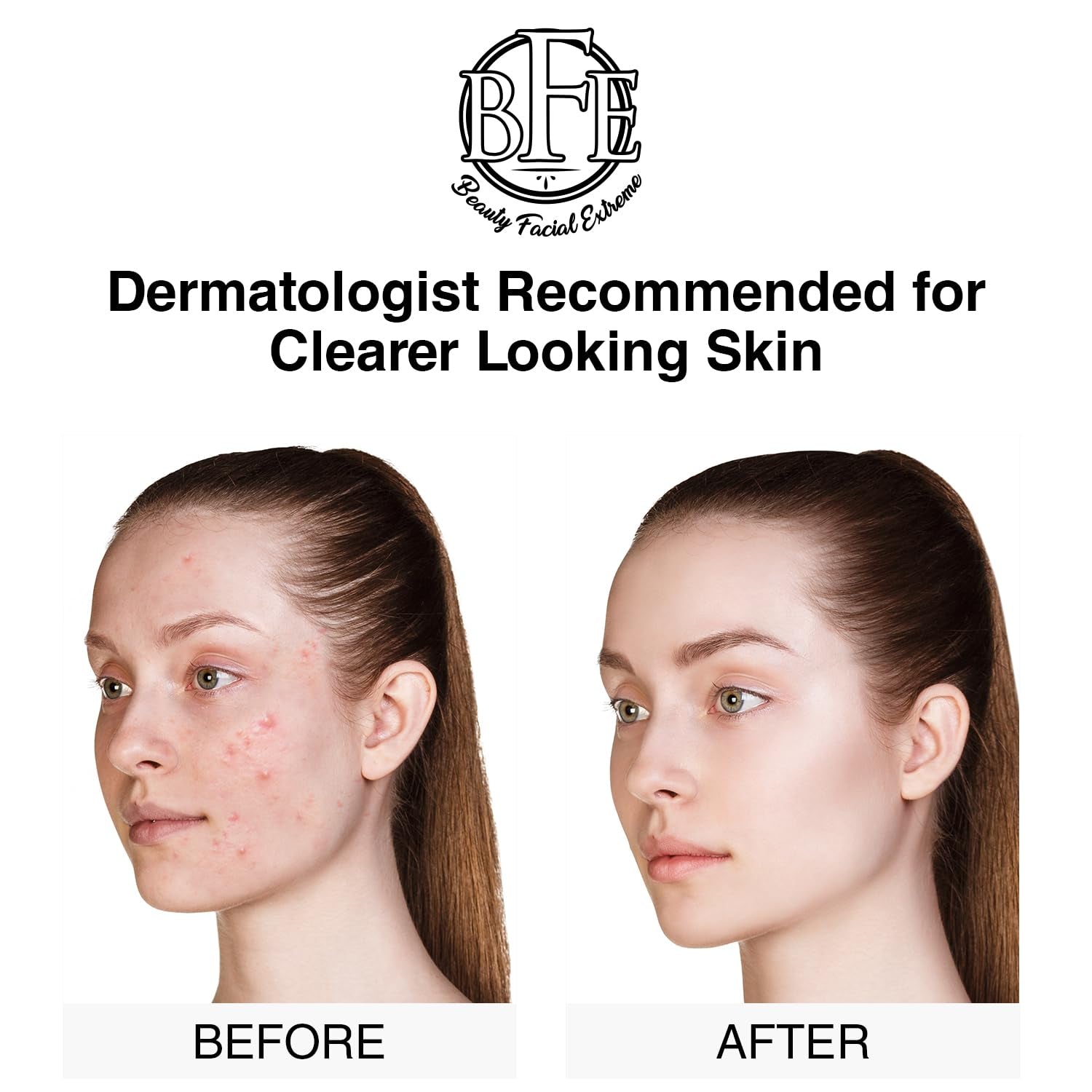 Beauty Facial Extreme Acne Treatment Pads 60 Pads | Salicylic, Glycolic & Lactic Acid Exfoliating Pads for Face & Body