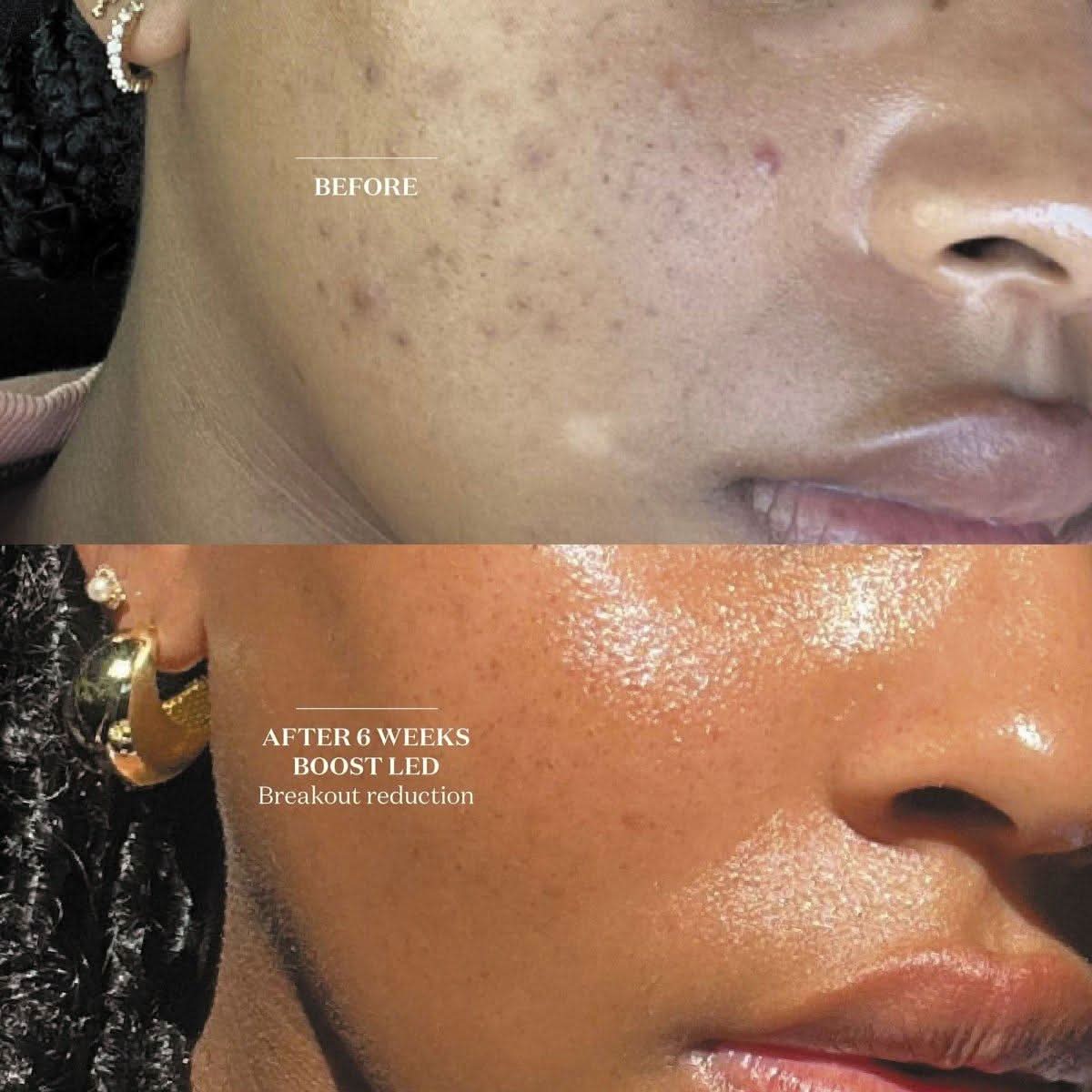 The Light Salon Boost LED Mask | Clinically Proven Skin Rejuvenation