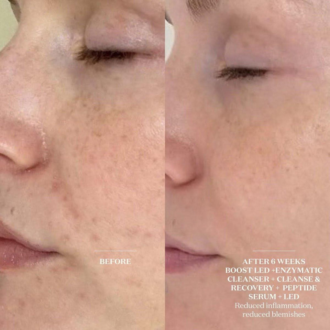 The Light Salon Boost LED Mask | Clinically Proven Skin Rejuvenation
