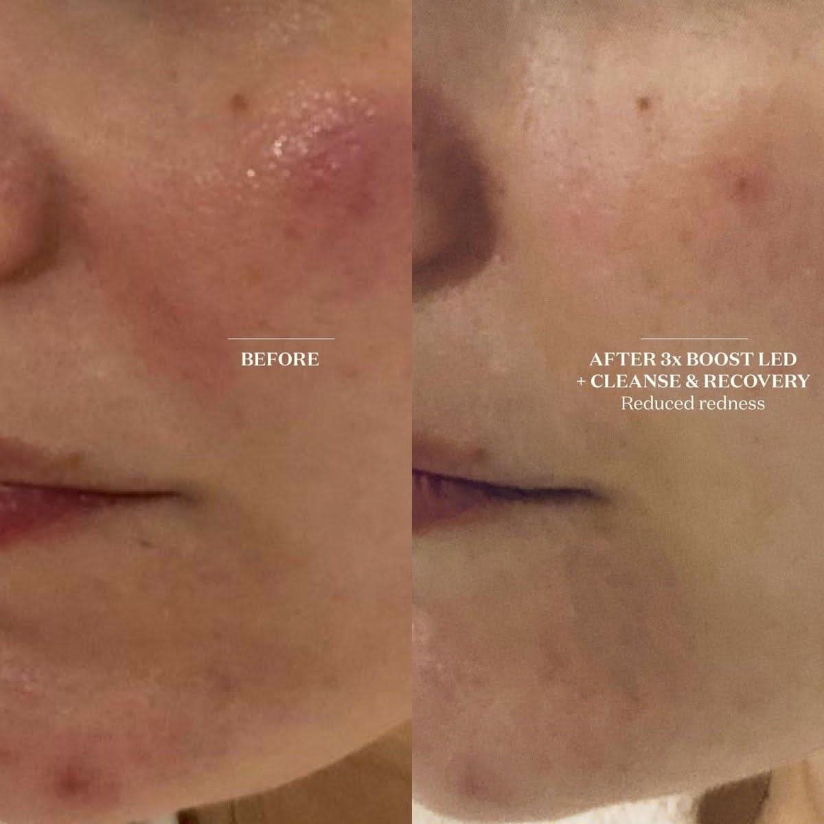 The Light Salon Boost LED Mask | Clinically Proven Skin Rejuvenation