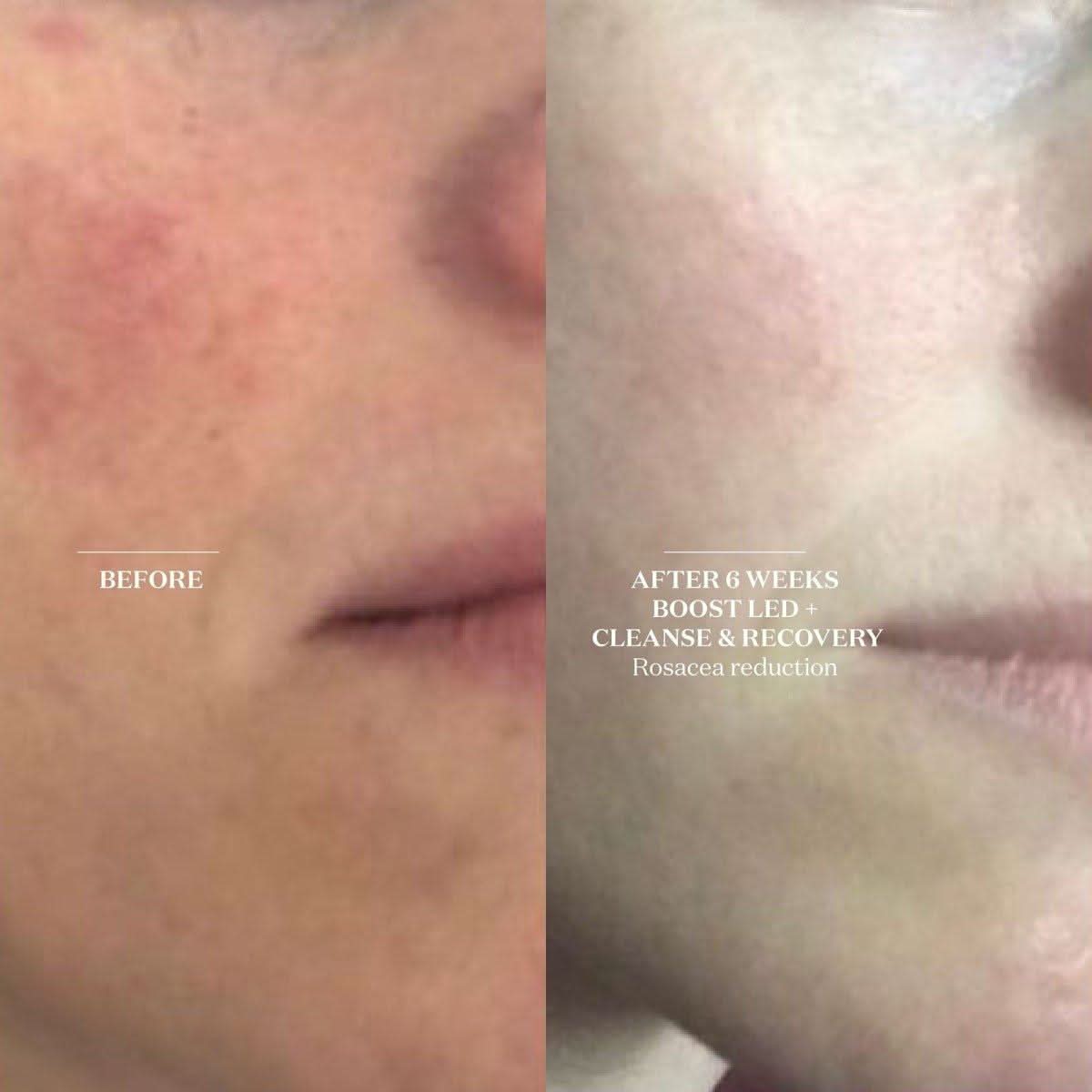 The Light Salon Boost LED Mask | Clinically Proven Skin Rejuvenation