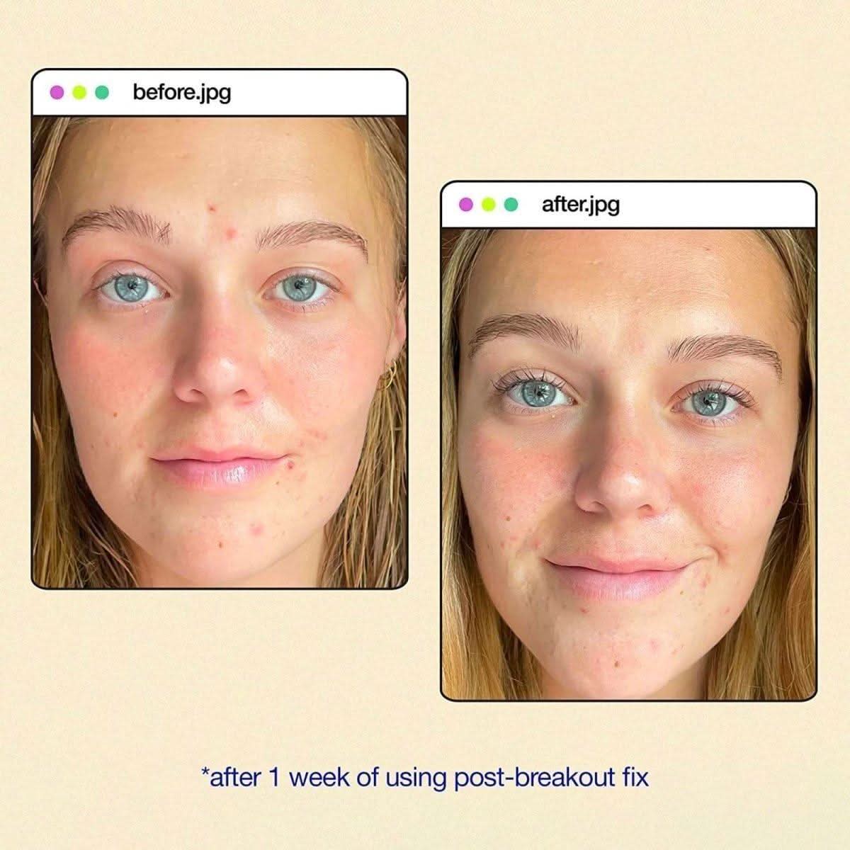 Dermalogica Clear Start Post-Breakout Fix | Targeted Treatment for Post-Breakout Marks