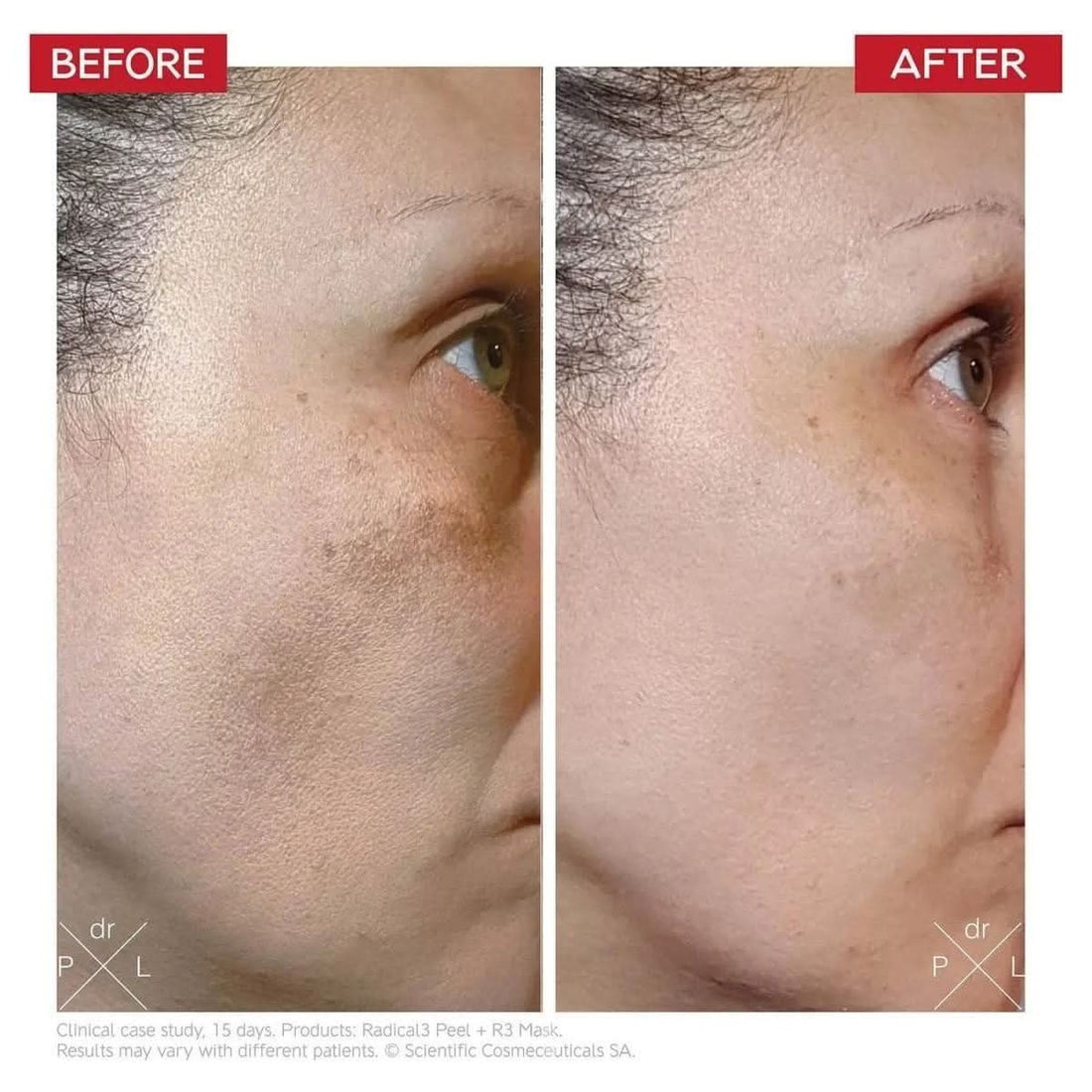 Dr. LEVY Switzerland Radical3 Reboot Pro Peel | The Clinic-Grade Resurfacer for a Total Skin Reboot!