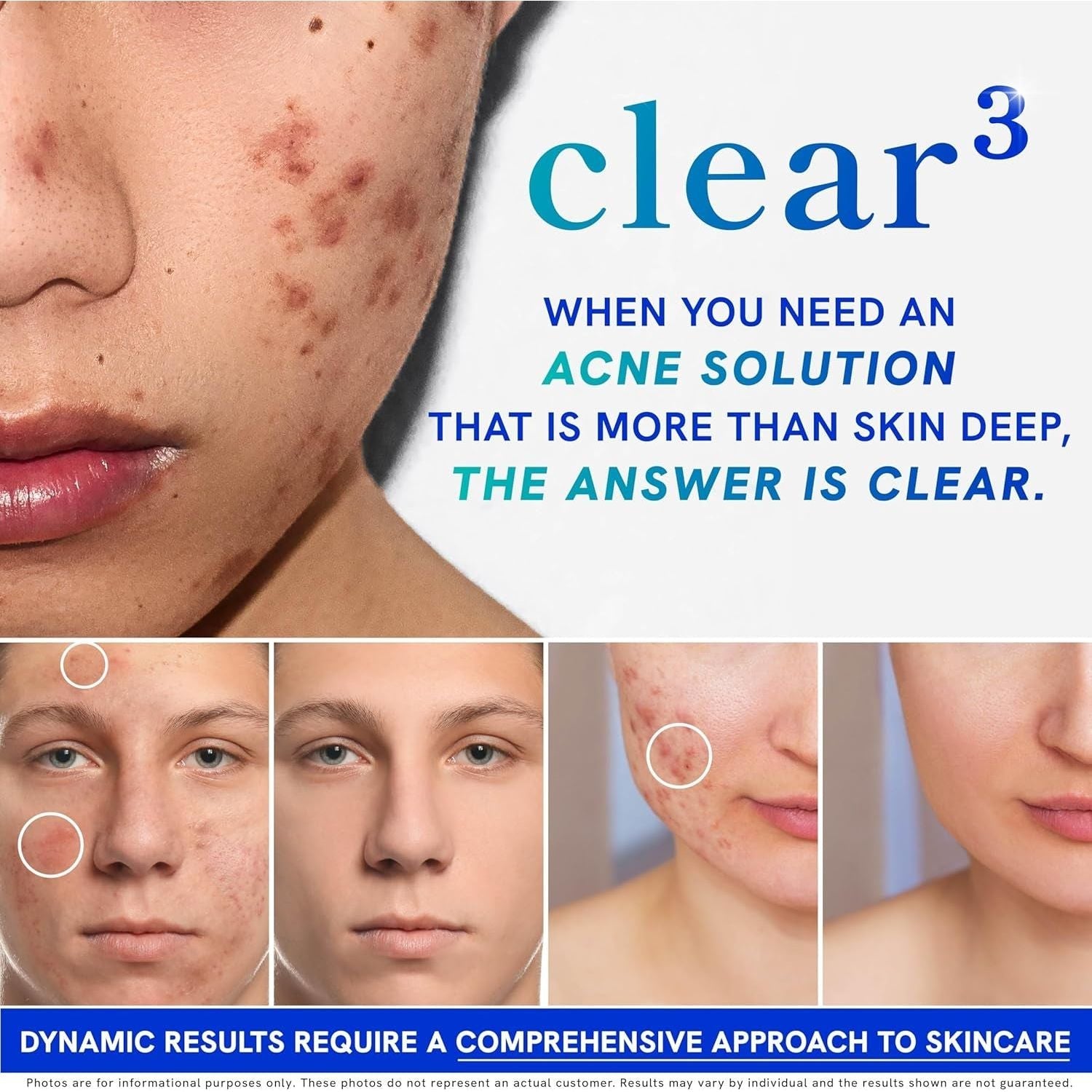 SM Nutrition Clear Acne Support – 120 Capsules | Triple-Action Hormonal, Gut & Skin Nutritional Acne Support