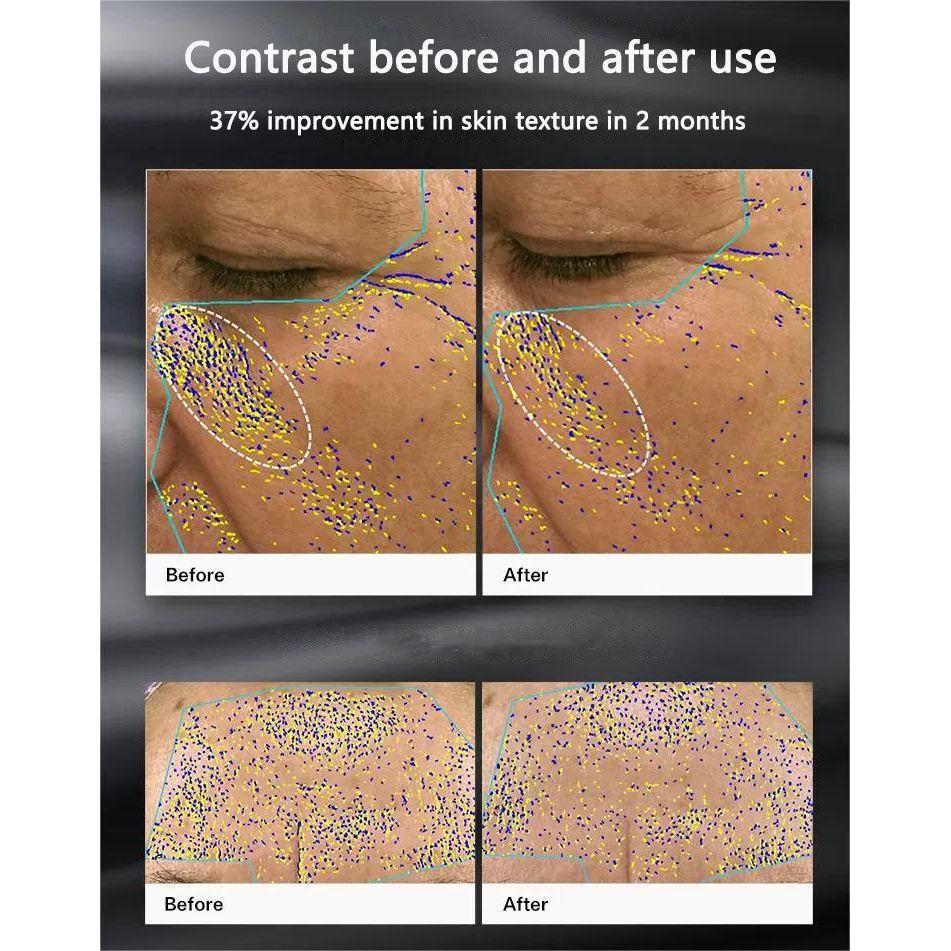 ENVIG EDGE RF Beauty Instrument | Advanced Non-Invasive Fractional RF Skin Rejuvenation