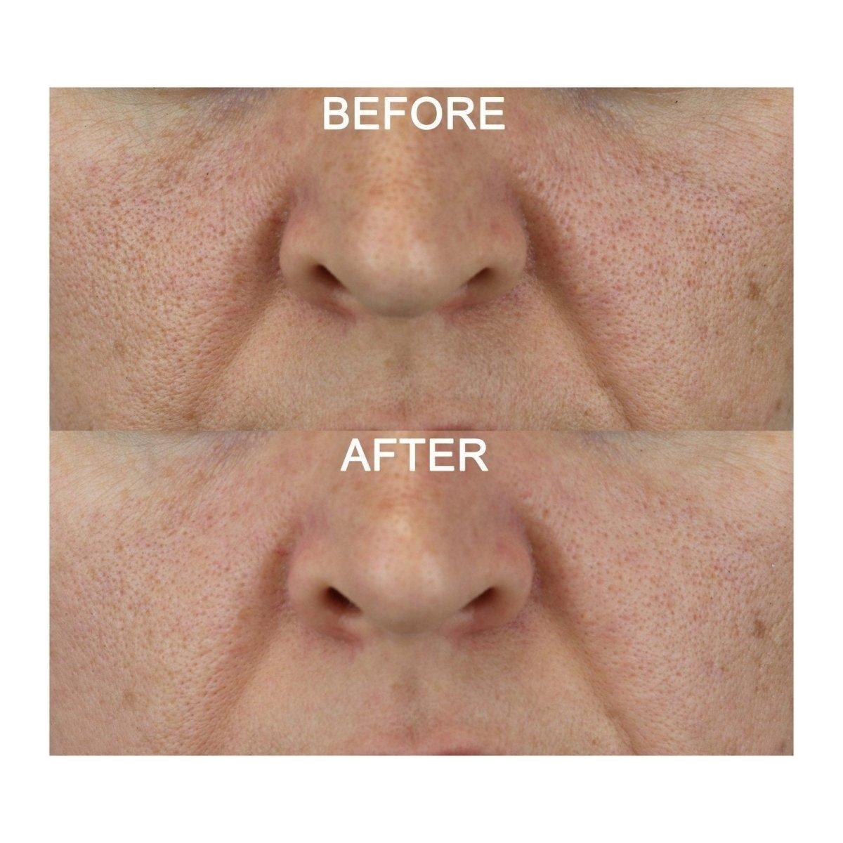 Medik8 Activated Charcoal Refining Mask Kit | Your At-Home Spa Detox!