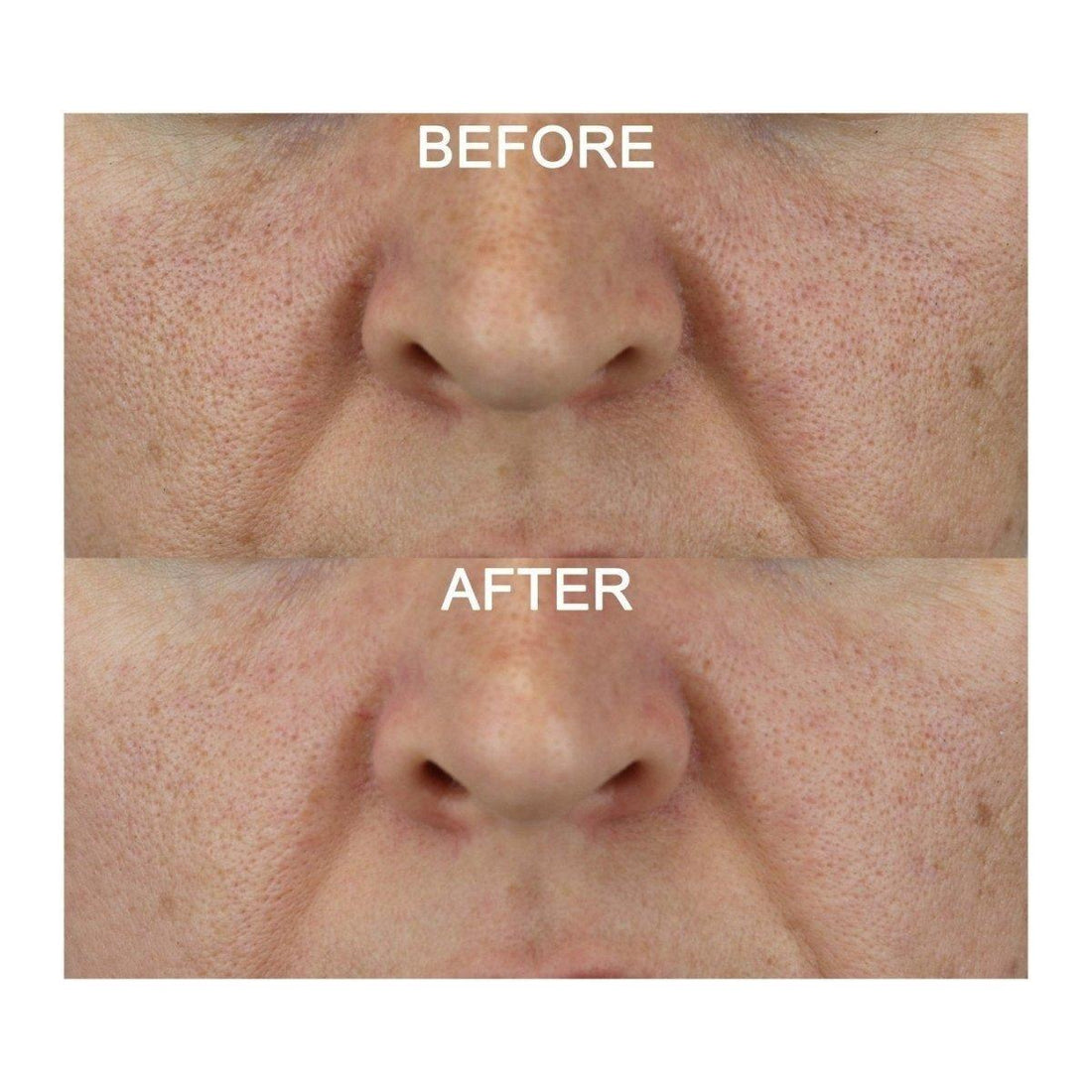 Medik8 Activated Charcoal Refining Mask Kit | Your At-Home Spa Detox!