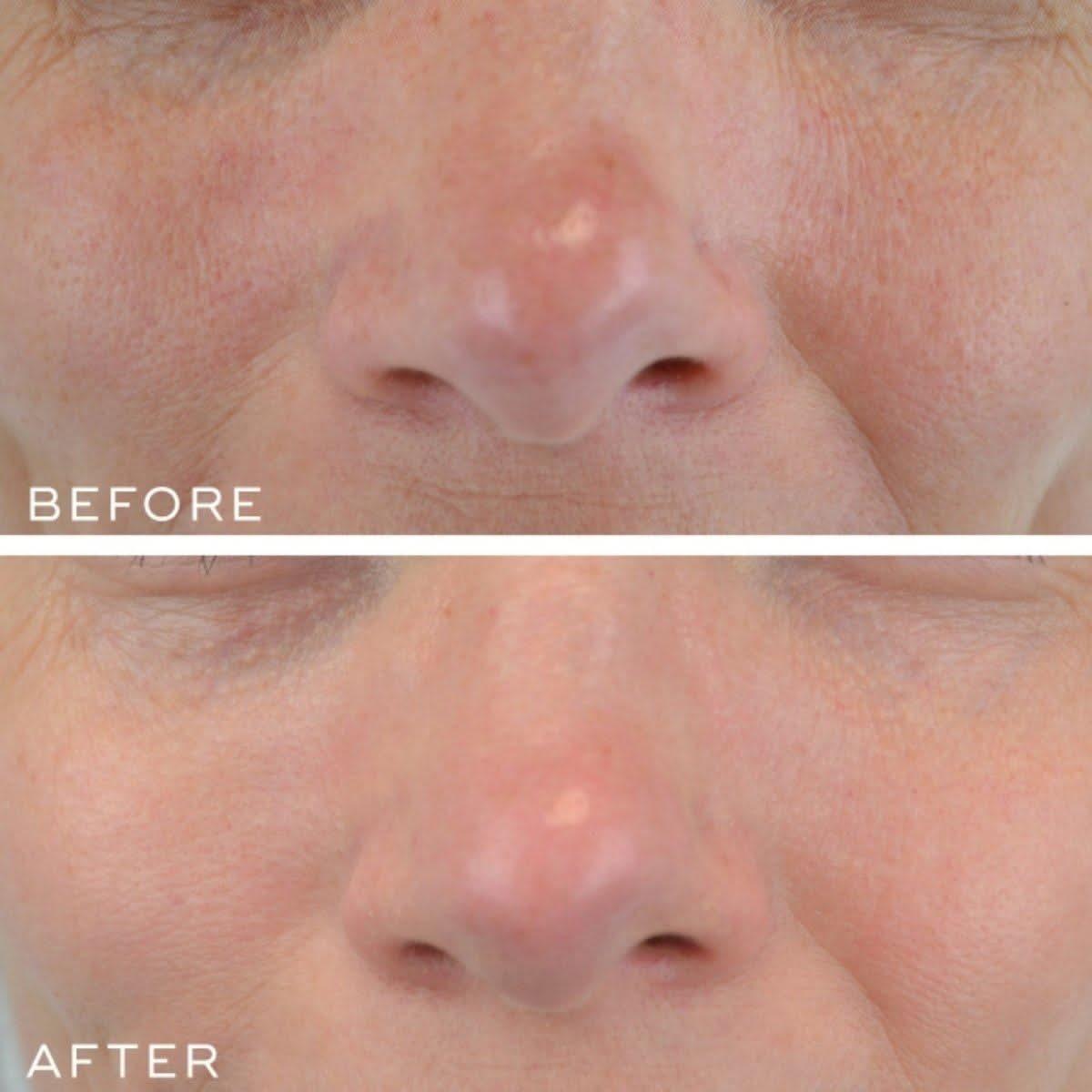 Medik8 Crystal Retinal 10 | The Non-Prescription Powerhouse for Dramatic Transformation!