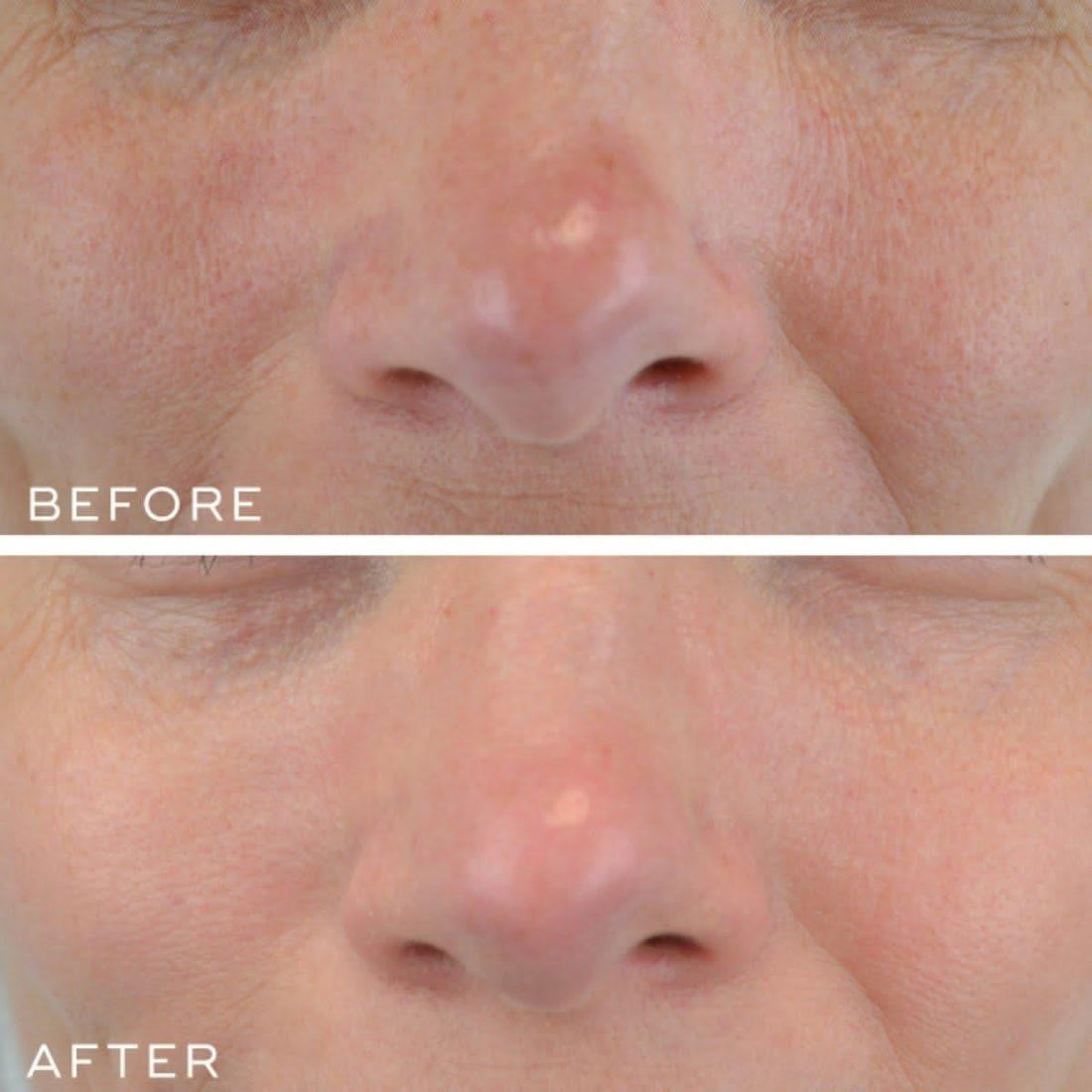 Medik8 Crystal Retinal 10 | The Non-Prescription Powerhouse for Dramatic Transformation!