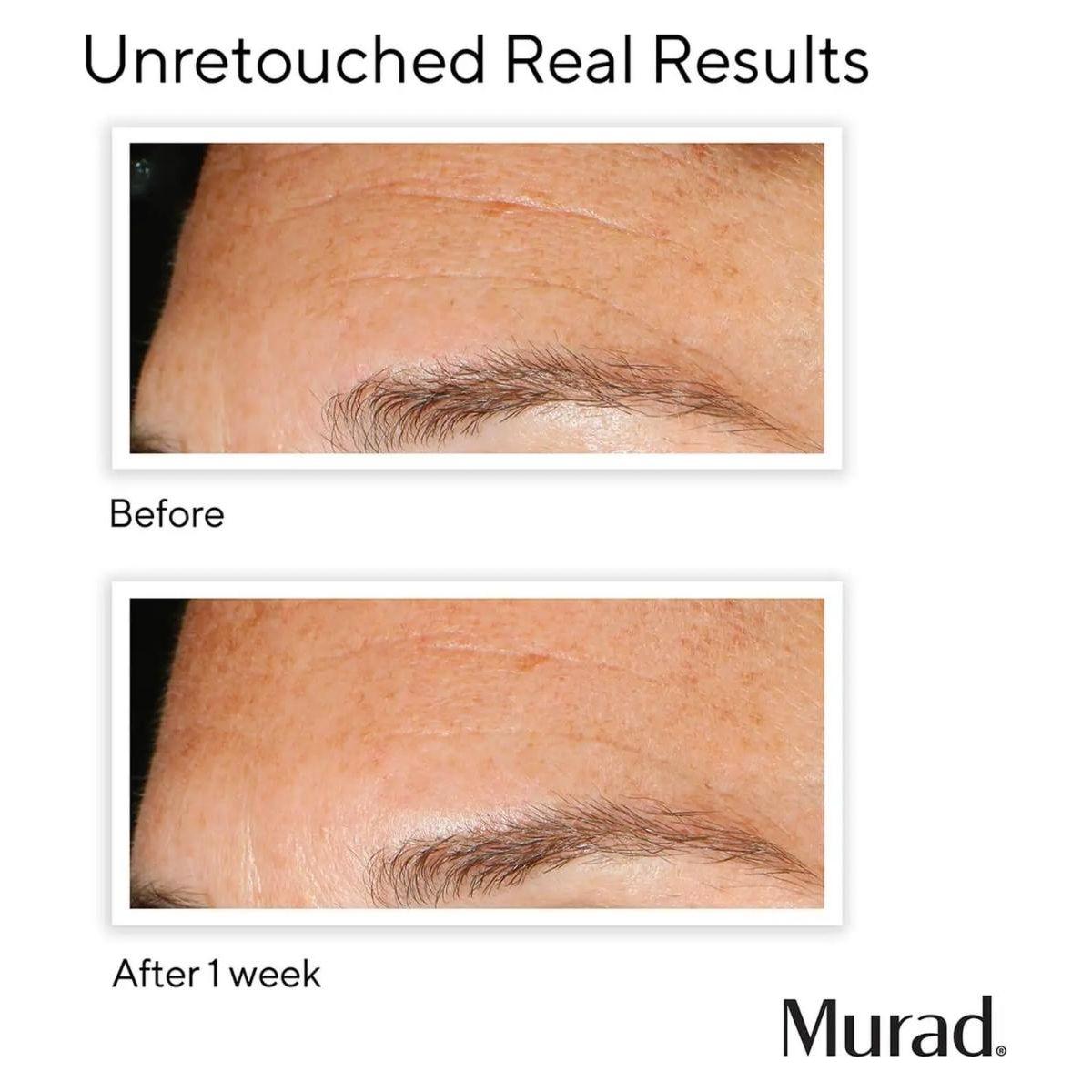 Murad Replenishing Multi-Acid Peel 100ml | Two-Phase Daily Peel for Glowing, Renewed Skin in Just 7 Days Resurface & Glow: Reveal 33% Fresher Skin in 1 Week!