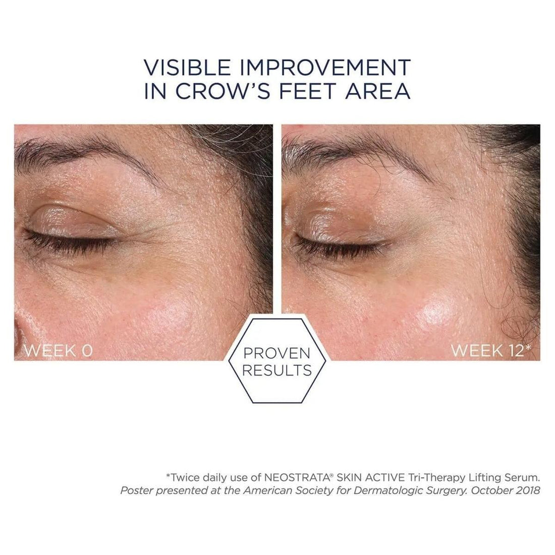 NeoStrata Tri-Therapy Lifting Serum | The Triple-Threat for Lifted, Plumper Skin!