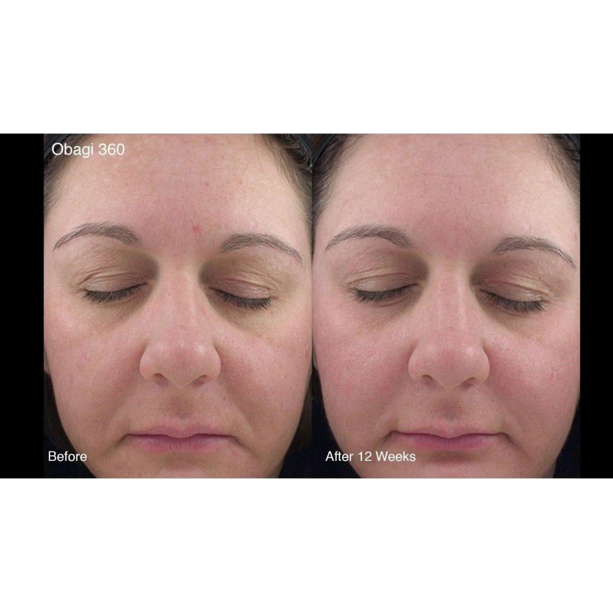 Obagi Medical 360 Exfoliating Cleanser 150ml Brightening, Smoothing & Dual-Action Exfoliating Cleanser