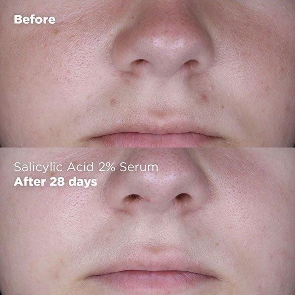 Skin Republic Salicylic Acid 2% Serum 30ml | Clears Blemishes & Reduces Oil in 7 Days