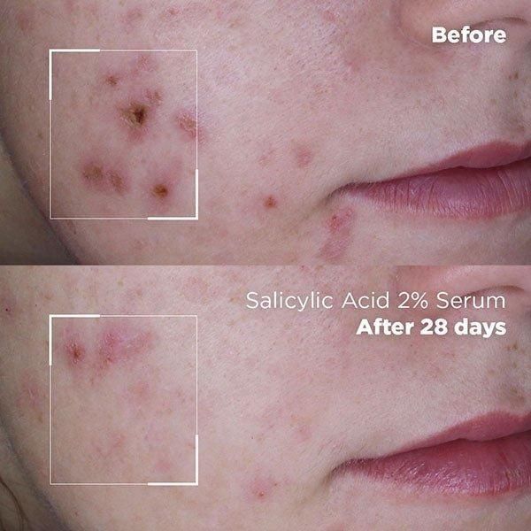 Skin Republic Salicylic Acid 2% Serum 30ml | Clears Blemishes & Reduces Oil in 7 Days